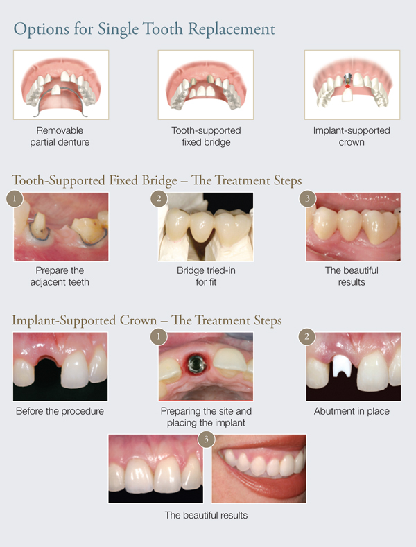 Why Dental Implants - Mississauga, Meadowvale, Streetsville, Milton, Georgetown, Brampton