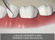 Scaling - Dental hygienist in Mississauga, Meadowvale, Streetsville, Milton, Georgetown, Brampton